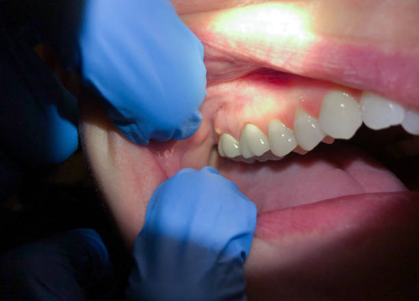 Best Emergency Dental Care for Broken or Chipped Teeth in Leona Valley, CA