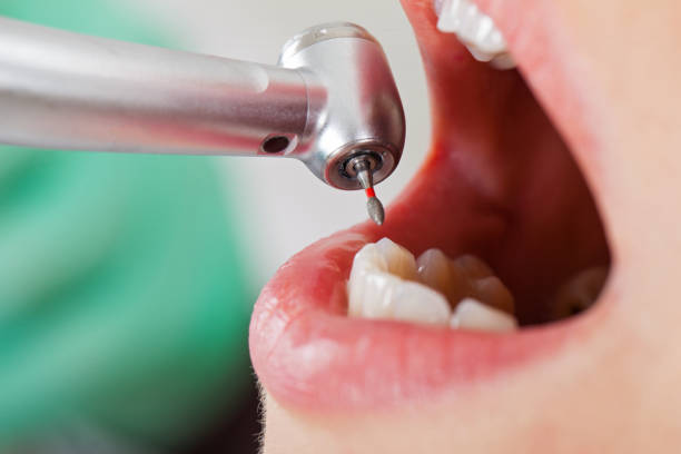 Best Emergency Treatment for Dental Infections or Abscesses in Leona Valley, CA
